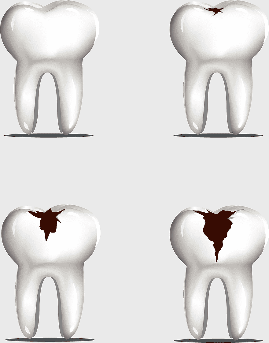 tooth decay illustration, molar tooth decay, painted dental decay, watercolor tooth art, dental health visuals, oral hygiene graphics, decayed tooth stages tooth decay illustration, molar tooth decay, painted dental decay, watercolor tooth art, dental health visuals, oral hygiene graphics, decayed tooth stages